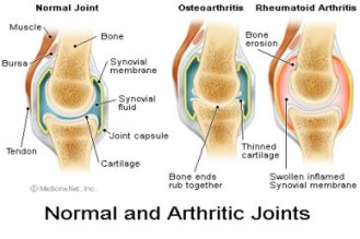 Arthritic Joints