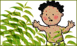 Neem for Chicken Pox