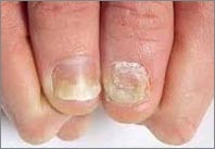 Nail Psoriasis