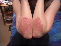 Psoriasis Treatment